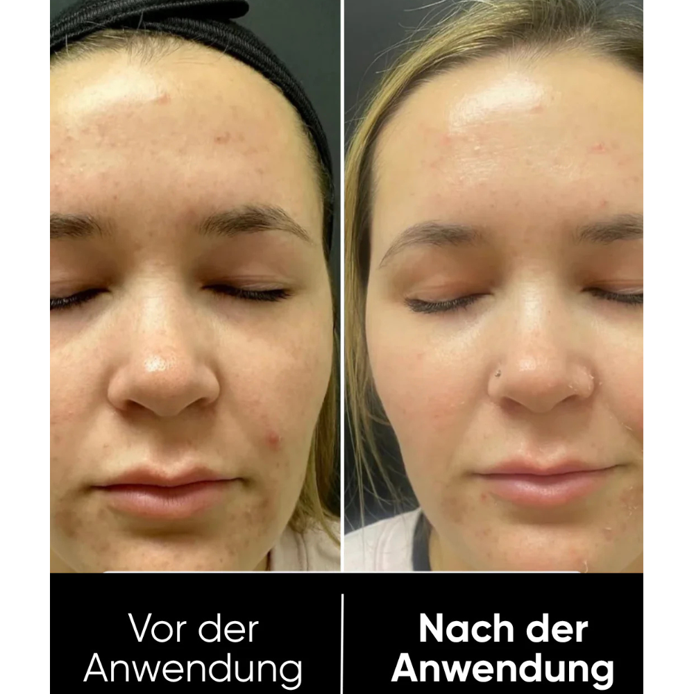Hanna Reis Peel Shot Duo - Des pores plus fins & une peau plus lisse en seulement 3 minutes