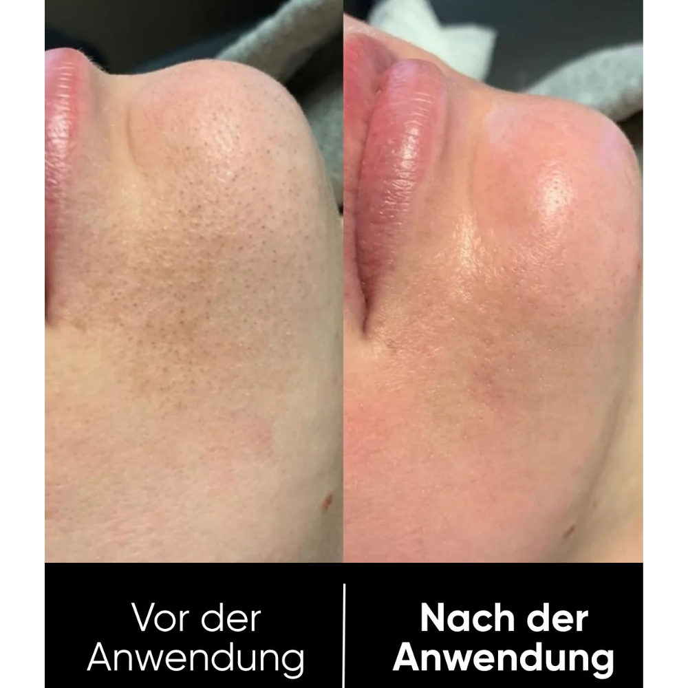 Hanna Reis Peel Shot Duo - Des pores plus fins & une peau plus lisse en seulement 3 minutes