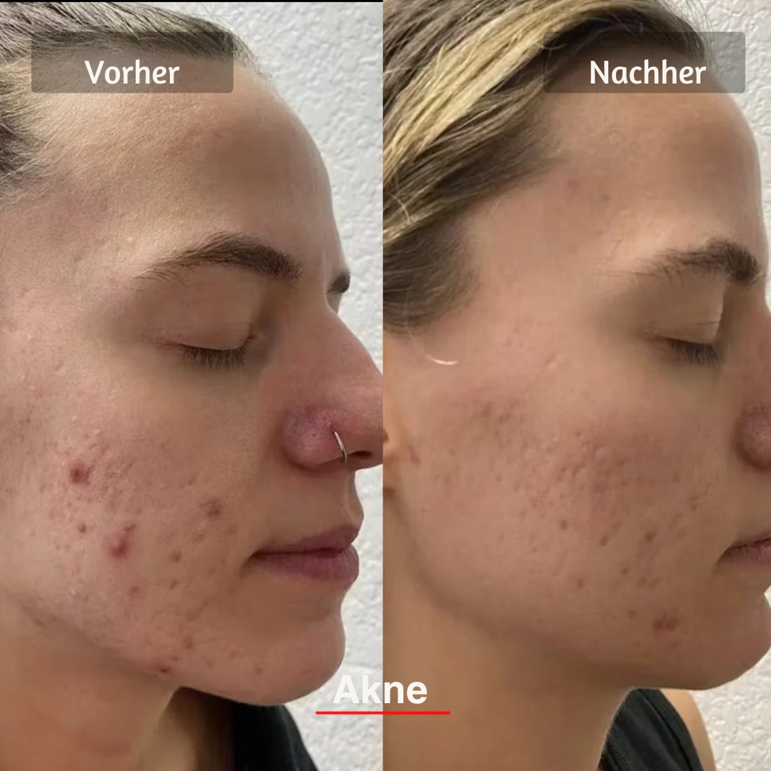 Masque LED visage HANNA PRO – Pour une peau plus lisse, plus ferme et visiblement plus fraîche