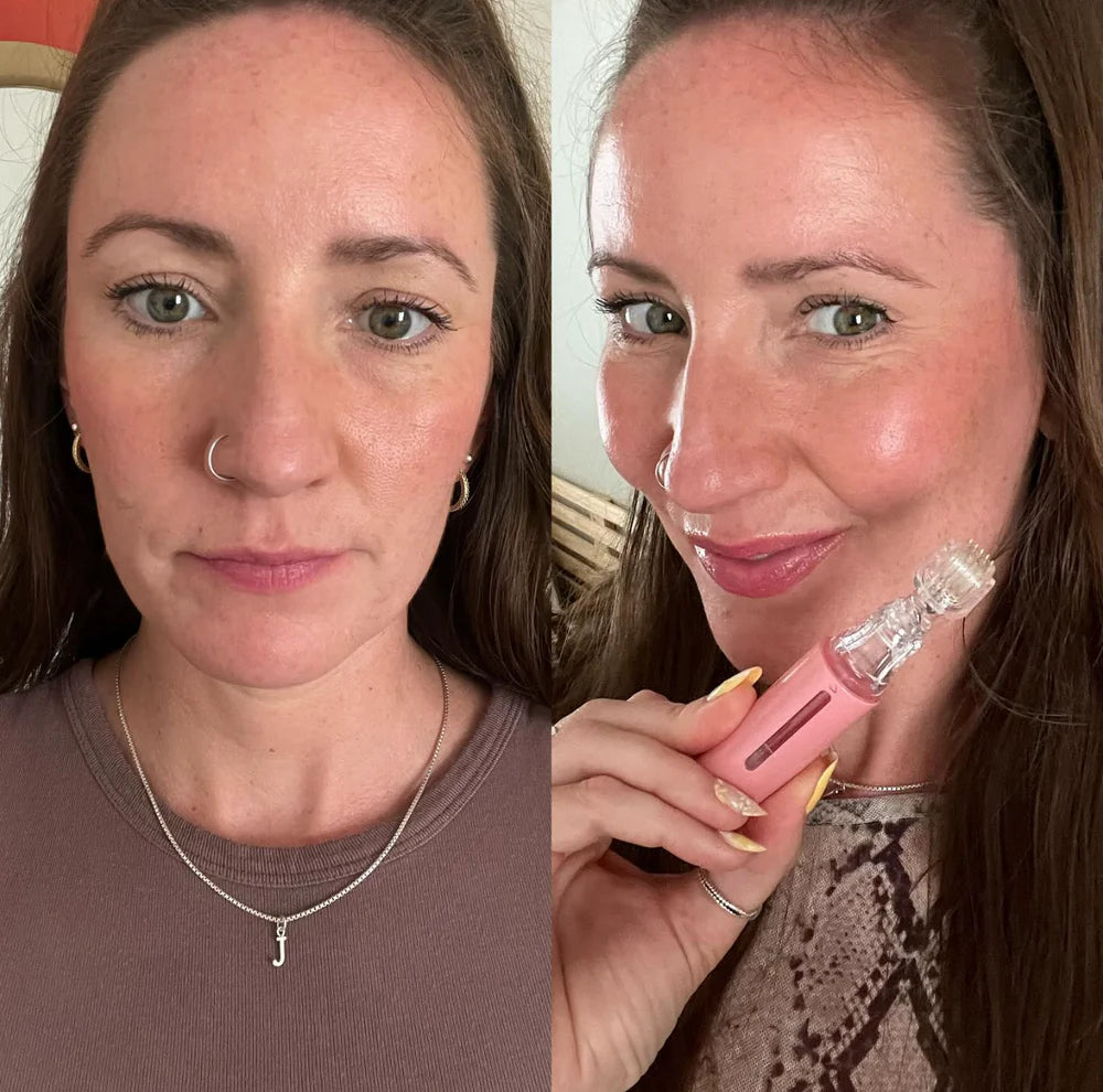 Conjunto Hanna LipBoost – Lábios visivelmente mais volumosos em apenas algumas semanas – totalmente natural e sem injeções.